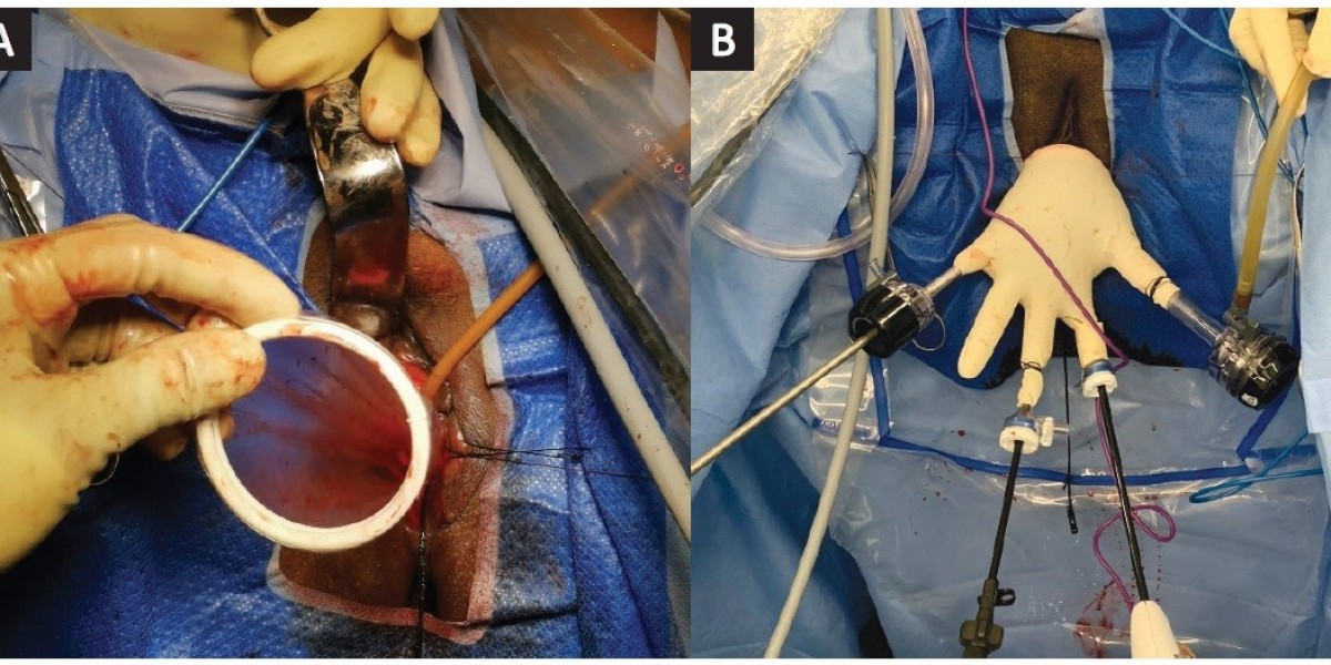 Advancement of vNOTES Surgery: A New Frontier in Minimally Invasive Gynecologic Care