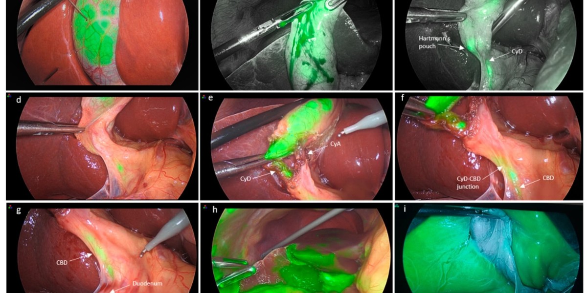 The Role of Indocyanine Green (ICG) in Laparoscopic Surgery: Enhancing Precision and Safety